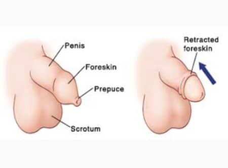 जानिए क्यों होता है पुरूषों के लिंग में दर्द और कैसे कर सकते हैं इसे दूर