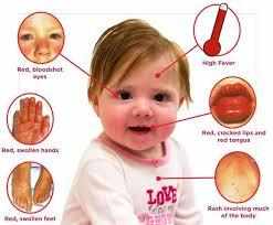 आइए जाने क्या है कावासाकी रोग, जानिए बच्चों में होने वाली इस बीमारी के लक्षण
