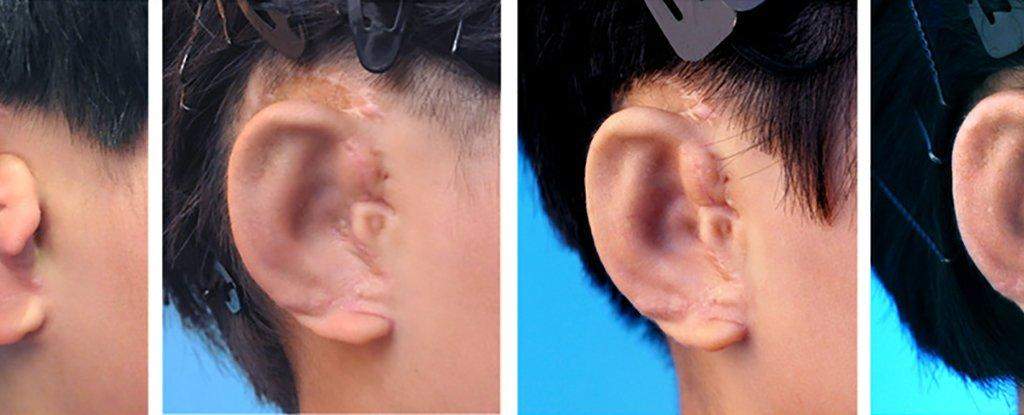 भारतीय डॉक्टर्स ने बनाया कृत्रिम कान, मेडिकल में नया अविष्कार