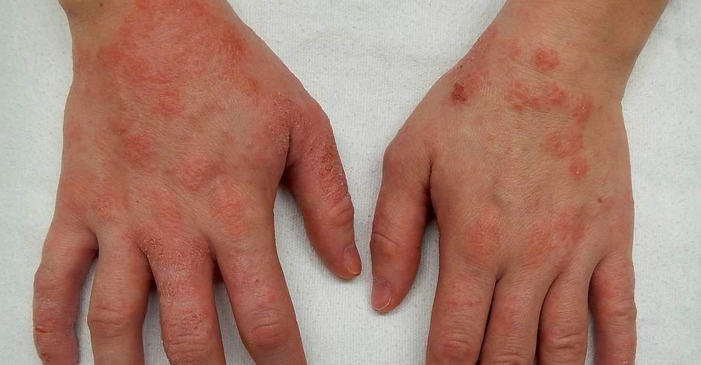 पर्यावरण एलर्जी से जुड़े एक्जिमा रोगियों में तीव्र खुजली,जानें रिपोर्ट