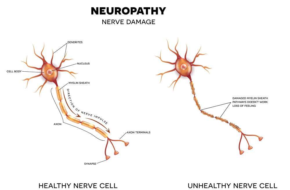 न्यूरोपैथी रोग क्या है और कैसे होता है? सब कुछ जान लीजिए