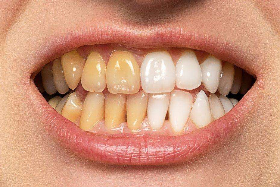 Teeth Whitening : 2 मिनट में दांतों के पीलेपन से छुटकारा पाने के लिए इन घरेलू उपायों को आजमाएं