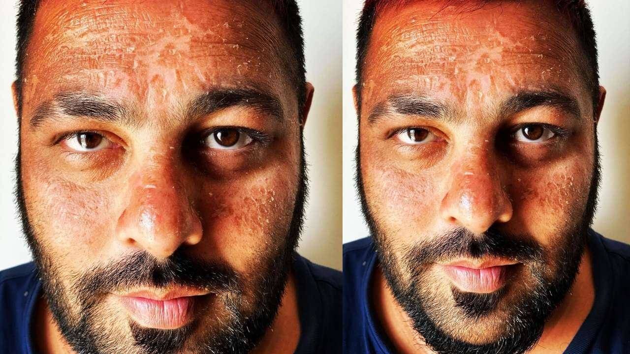 Badshah gets sunburnt: मालदीव वेकेशन बादशाह को पड़ी भारी, झुलस गया पूरा चेहरा वरूण धवन भी हुए इसके शिकार