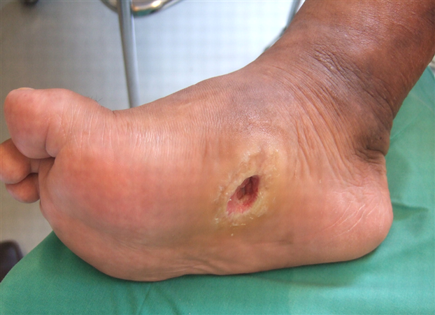 एक गंभीर रोग के संकेत होते है पैरों में अल्सर होना