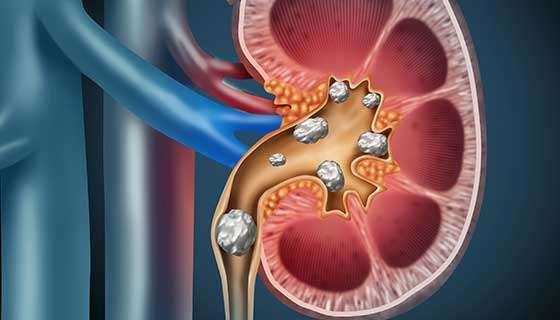 Kidney Stone: गुर्दे की पथरी से पीड़ित? फिर, गलती से भी यह खाना न खाएं