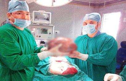 डॉक्टरों ने महिला के पेट से निकाला 24 किलो का ट्यूमर