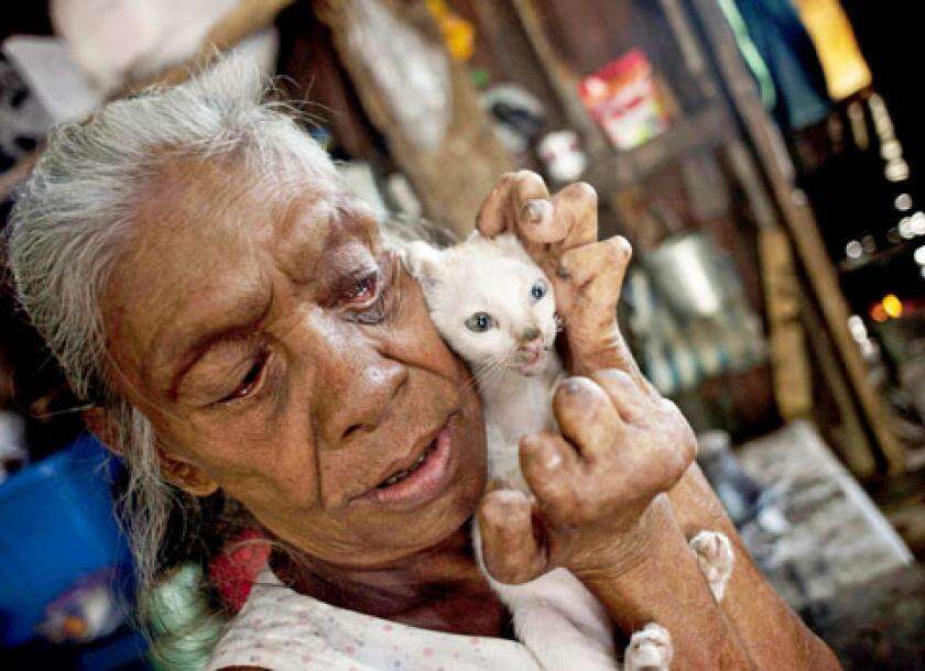 खुलासा, जानकारी के अभाव में बनता है कुष्ठ रोग इस गंभीर रोग का कारण