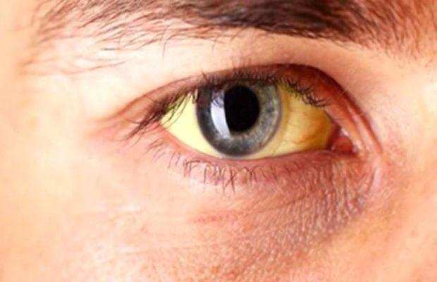 क्या आप जानते हैं आंख के पीले धब्बे डिमेंशिया के संकेत हो सकते हैं !