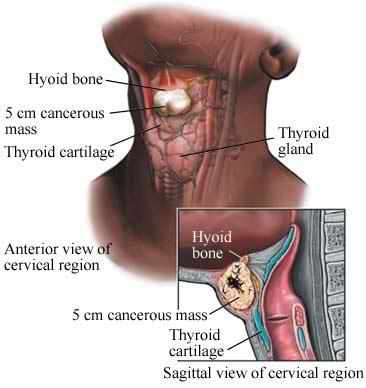  जाने थाइरोइड कैंसर के  कुछ प्रकार
