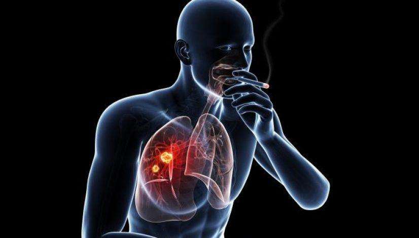 धूम्रपान छोड़ने के इतने वर्षों बाद भी हो सकता है लंग कैंसर
