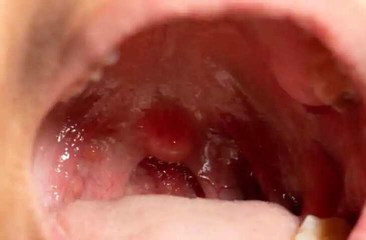 Health Alert: टॉन्सिल कैंसर का पहला संकेत क्या है? जानिए शुरुआती लक्षण और पहचान का तरीका