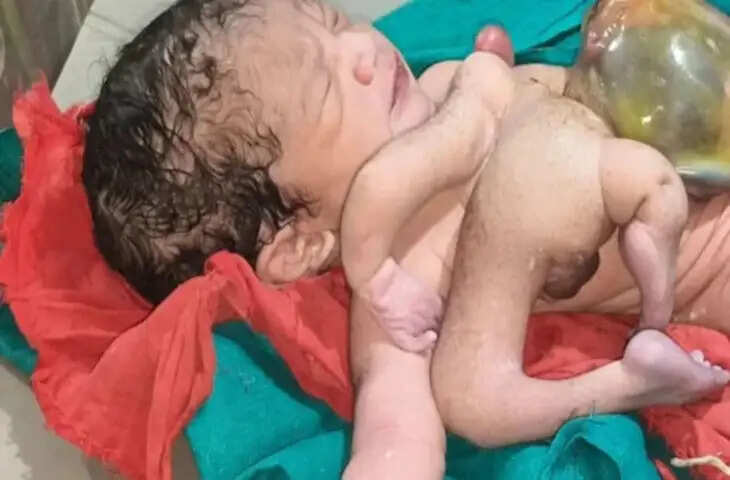 छतरपुर में 4 हाथ-पैर वाले बच्चे का जन्म, अतिरिक्त धड़ भी जुड़ा, देख हैरान हुए लोग, जानिए डॉक्टर ने क्या कहा?