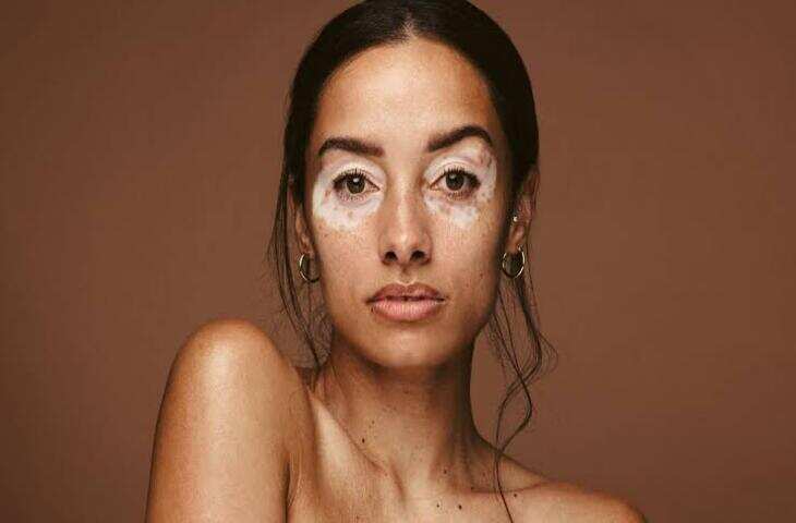  त्वचा पर सफेद दाग देखकर शर्माने की जरूरत नहीं, जानिए Vitiligo की सच्चाई✓