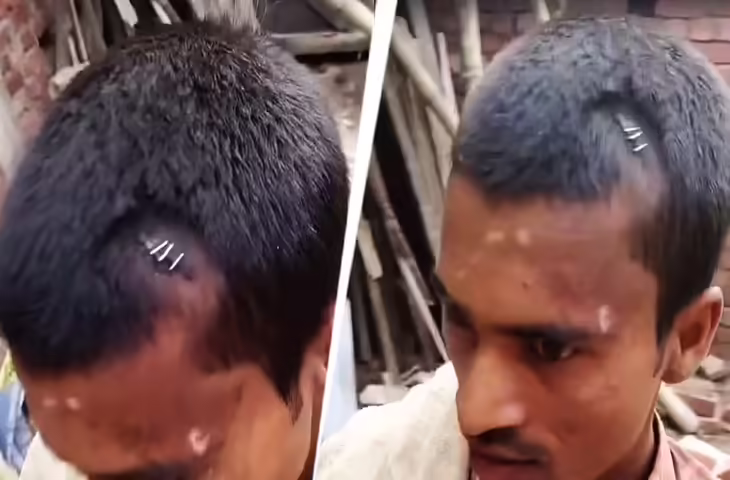 'गजब&nbsp;डॉक्टर है भाई....' सिर में आई चोट तो टांकों की जगह ठोक दिए स्टेपलर पिन, वीडियो देख उड़ जाएंगे होश&nbsp;