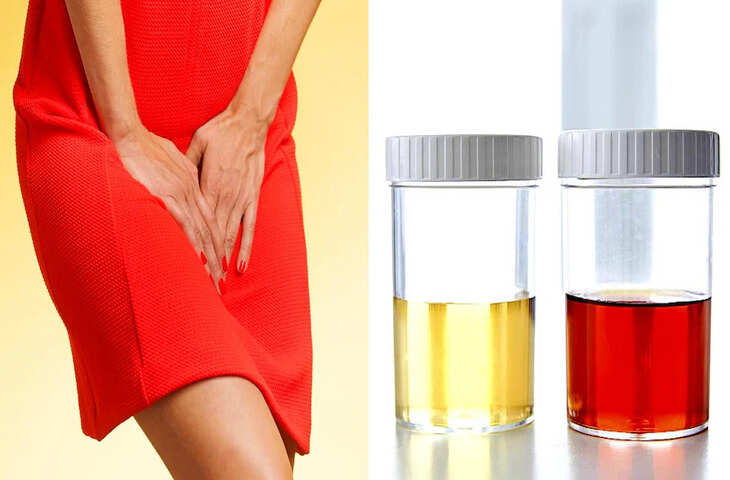 पेशाब में खून आने के पीछे की खतरनाक वजहें, समय पर पहचानना है जरूरी वरना मुसीबत में पड़ सकती है जान&nbsp;