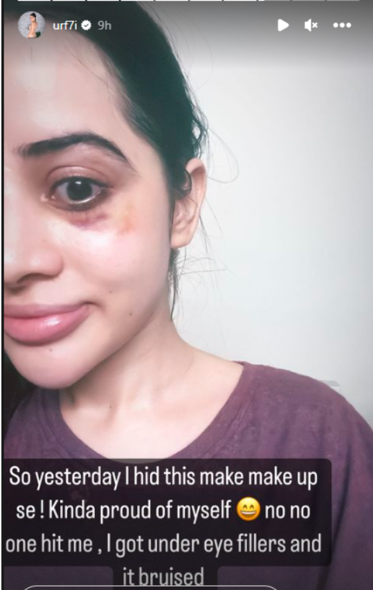 उर्फी जावेद ने शेयर की आंखों के नीचे काले घेरे और चोट के निशान वाली तस्वीरें, अंडर आई क्रीम को बताया स्कैम 