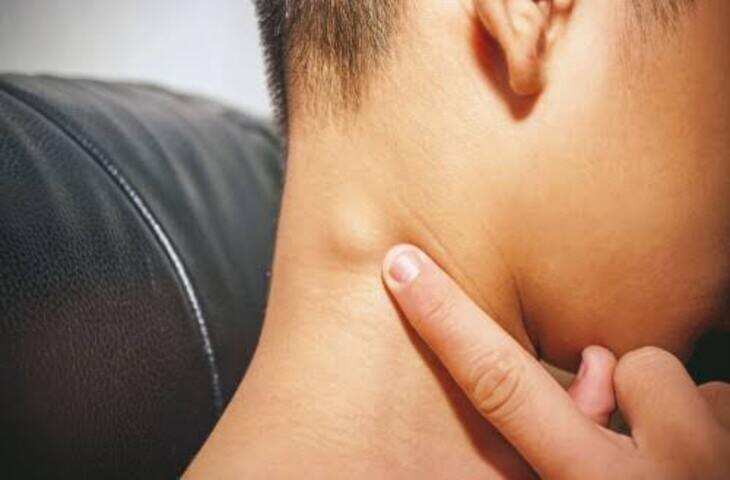 लिंफ नोड्स की सूजन कब बनती है कैंसर का संकेत? जानें कितने दिनों बाद तुरंत डॉक्टर को दिखाना जरूरी