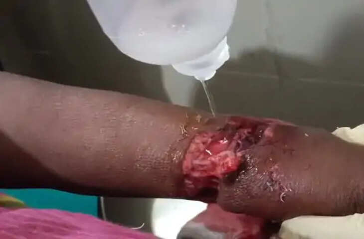 बांसवाड़ा में आवारा कुत्ते का आतंक, 55 वर्षीय महिला पर हमला; हाथ बुरी तरह जख्मी