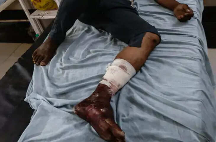 ट्रैक्टर चलाने को लेकर विवाद में युवक पर लाठी-डंडों से हमला, पैर में फ्रैक्चर