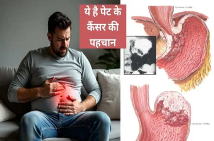 पेट में कैंसर की शुरुआत में नजर आते हैं ये 5 लक्षण, अनदेखा किया तो जान पर आ सकती है बात&nbsp;