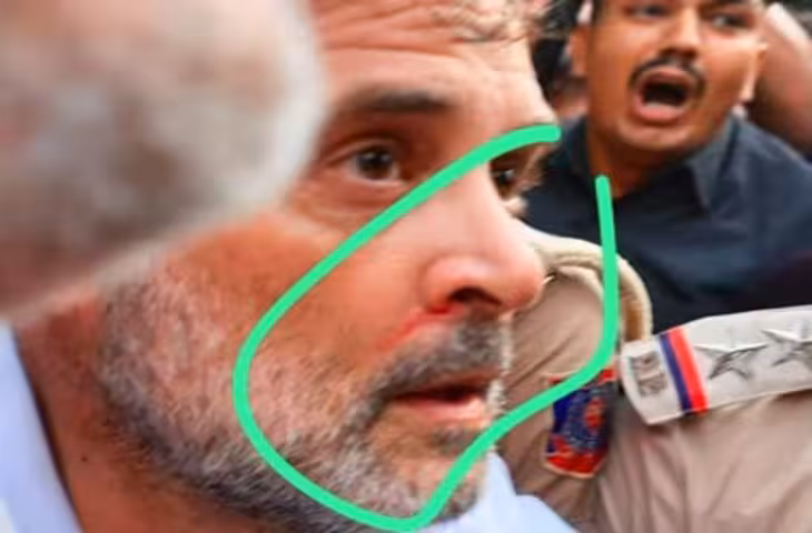 नाक से खून, छाती पर चोट... प्रदर्शन के बाद राहुल गांधी की तस्वीर वायरल, कांग्रेस ने बताया पूरा मामला