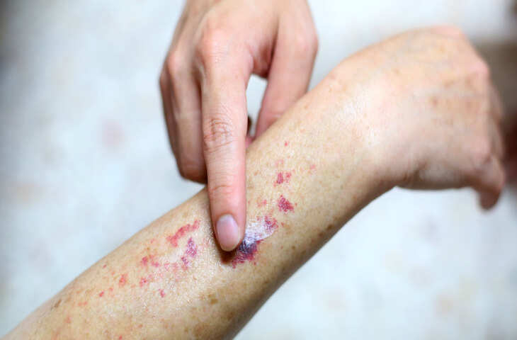 चोट के निशान और कंधे के दर्द को ना ले हल्के में ये हो सकते है खतरनाक Blood Cancer के संकेत, जाने कैसे करे पहचान&nbsp;