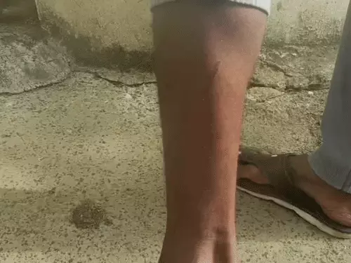रीवा में युवक का आरोप- कुत्ते ने काटा, लगा दिया सांप वाला इंजेक्शन; पर्ची में लिखा 'अननोन स्नेक बाइट'