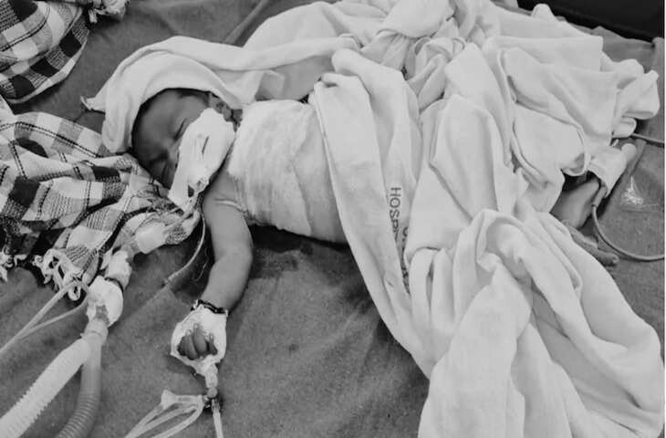 कुत्तों के हमले में घायल बच्चे की मौत, अस्पताल में वेंटिलेटर पर चल रहा था इलाज