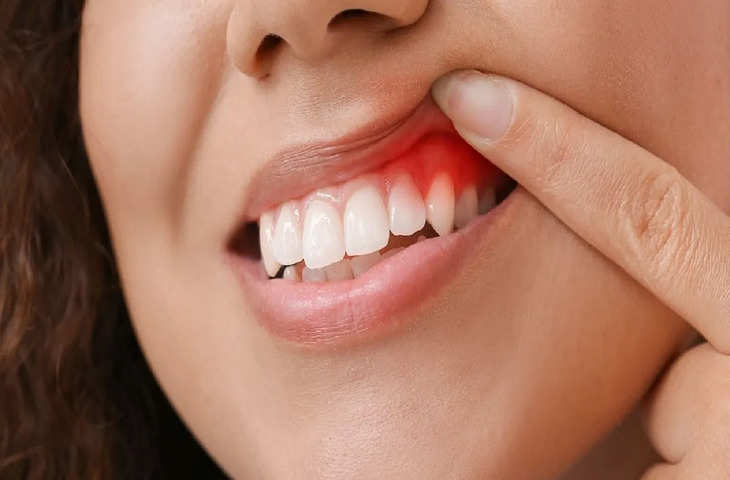 अगर ब्रश करते समय दांतों से निकलता है खून तो हो सकती है यह वजह 