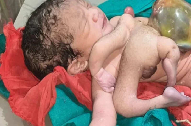 मध्य प्रदेश के छतरपुर में जन्मा चार हाथ-चार पैर वाला बच्चा, दुर्लभ मामला देख डॉक्टर भी हुए हैरान