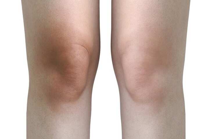 Dark Knees Home Remedies: घुटनों के कालेपन की समस्या से मिलेगा छुटकारा, स्किन एक्सपर्ट के ये टिप्स जरूर आजमाएं