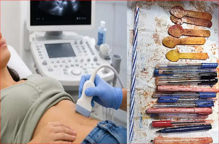 महिला के सीने में उठा तेज दर्द&hellip; सर्जरी हुई तो पेट से निकले पेट से निकले 14 पेन, 5 चम्मच और एक मोमबत्ती