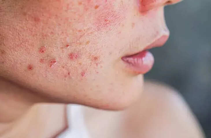 Acne on woman face