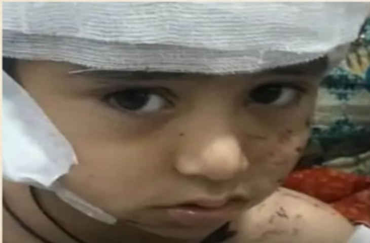 स्कूल के पहले दिन 4 साल के मासूम पर कुत्तों का हमला, सिर की चमड़ी नोची; चीख भी नहीं सुन पाया स्टाफ