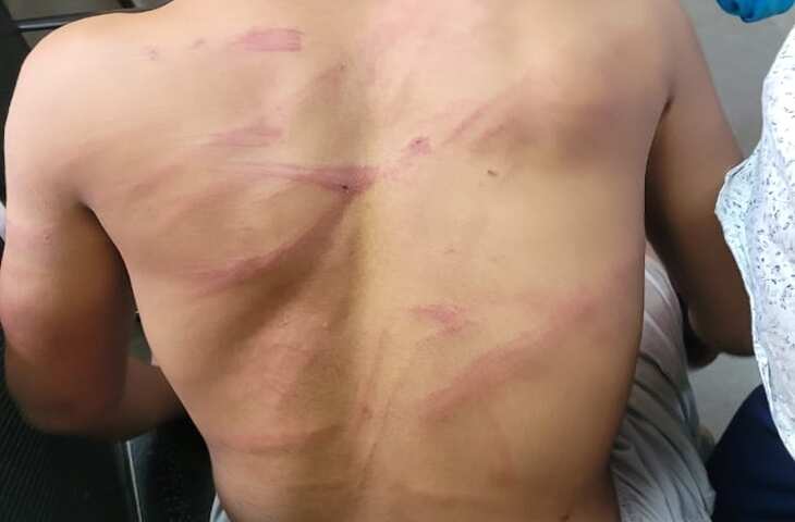3 रुपए के लिए टीचर ने बच्ची को डंडे से पीटा, पीठ पर हुए घाव, छात्रा ने ग्राउंड में गिरे पैसे उठा लिए थे, वीडियो में समझें पुरा मामला