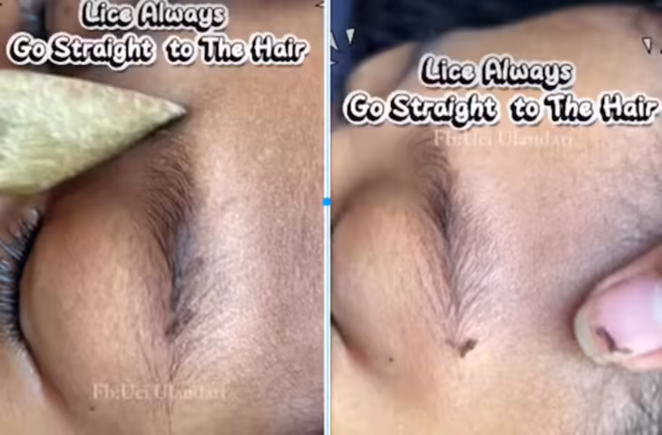 सोशल मीडिया पर आईब्रोज में जूं मिलने का वीडियो वायरल, स्वच्छता और स्वास्थ्य को लेकर चर्चा तेज