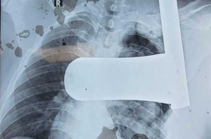 उदयपुर के RNT मेडिकल कॉलेज में चमत्कार, युवक के सीने से 9 इंच लंबा लोहे का पाइप निकाल बचाई जान