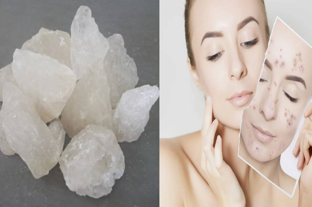 चेहरे पर फिटकरी लगाने से ये होते हैं फायदे