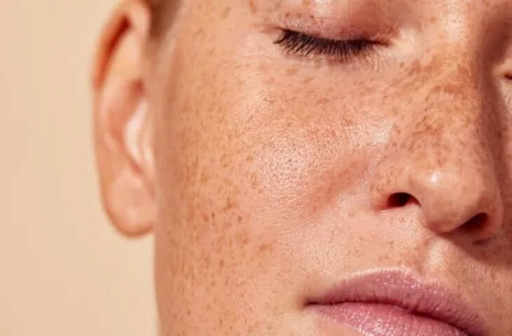Skin Care Tips: चेहरे की झाइयों से पाएं छुटकारा, स्किन एक्सपर्ट ने बताया 90% तक झाइयां कम करने का फॉर्मूला