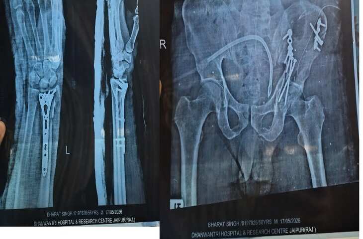SMS अस्पताल में इलाज पर सवाल: एक्सक्लूसिव फुटेज में जाने ऑपरेशन के नाम पर पैसे मांगने और बिना सर्जरी डिस्चार्ज का आरोप, परिजनों में आक्रोश
