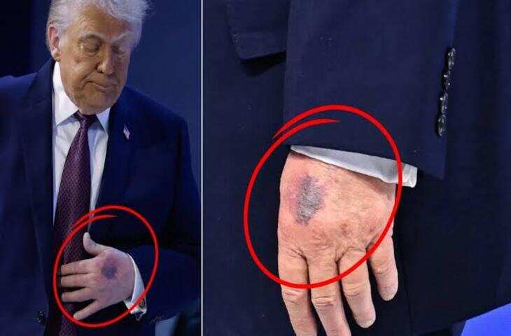 Trump Health: ट्रंप की सेहत पर क्या छिपा रहा व्हाइट हाउस? पूर्व राष्ट्रपति के डॉक्टर ने उठाए गंभीर सवाल