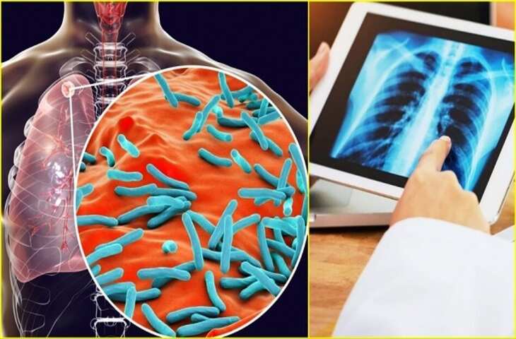 Bone Tuberculosis: हड्डियों में टीबी कब और कैसे होती है? एक्सपर्ट से जानें इसके लक्षण, कारण और बचाव के तरीके​​​​​​​