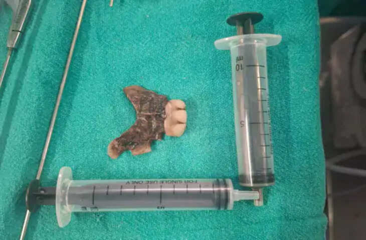 MP News: नींद में गले में फंस गए नकली दांत, ऑक्सीजन लेवल गिरा; डॉक्टरों ने बचाई मरीज की जान