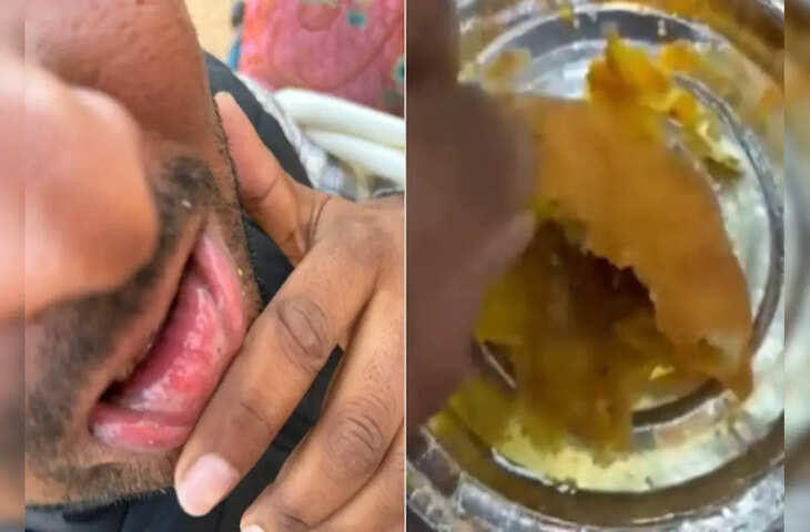 कचौरी में निकली ब्लेड, युवक का होंठ कटा, फुटेज में जानें शिकायत करने पर दुकानदार करने लगा दादागिरी