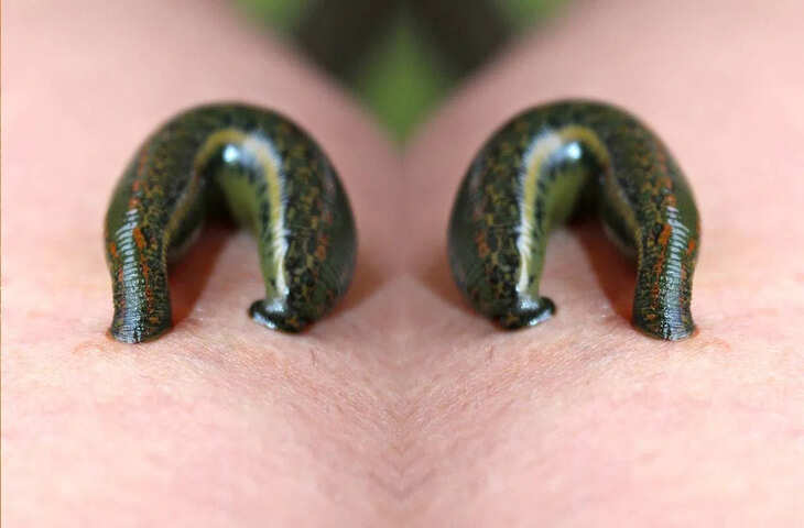 हैरान करने वाला मामला: ऑनलाइन इलाज के चक्कर में युवक ने शरीर में डाल ली जोंक, अस्पताल पहुंचते ही मची अफरा-तफरी​​​​​​​