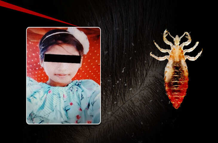 ओडिशा में 12 साल की बच्ची की मौत ने सबको चौंकाया, जाने&nbsp;मामूली जुएं कैसे बन सकती है जानलेवा ?