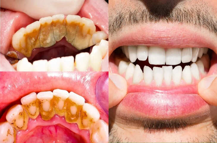 पीले दांतों से परेशान हैं? बस 3 नेचुरल टिप्स से चमकेंगे दांत, मोतियों जैसा सफेद और मसूड़े मजबूत बनाने का आसान तरीका