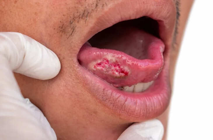 Oral Cancer Alert: मुंह में घाव नहीं, खतरे की घंटी! 2 हफ्तों तक न भरने वाले घाव हो सकते हैं कैंसर का लक्षण​​​​​​​