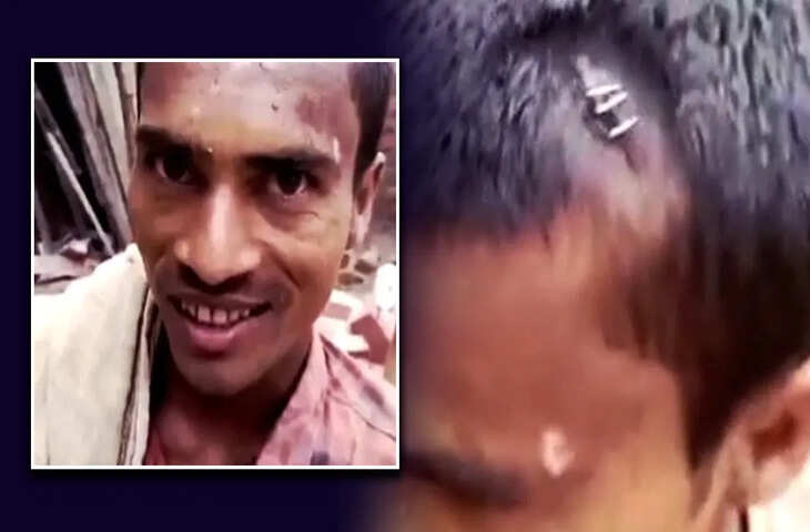 ये &lsquo;झोलाछाप&rsquo; मार डालेंगे&hellip; सिर फटा तो डॉक्टर ने टांके की जगह लगा दिया स्टेपलर पिन, Video वायरल