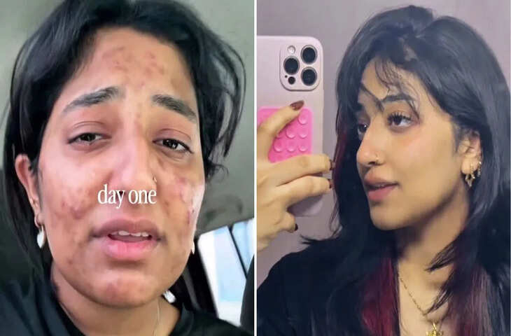 Viral Acne Transformation: महंगे ट्रीटमेंट को कहा अलविदा! 23 साल की लड़की ने 2 आसान आदतों से पा ली ग्लोइंग स्किन